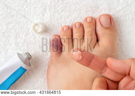 Gel For Bruises On The Index Finger Over Bruised Toe Of Female Person Foot. Injury Of Foot Little Fi