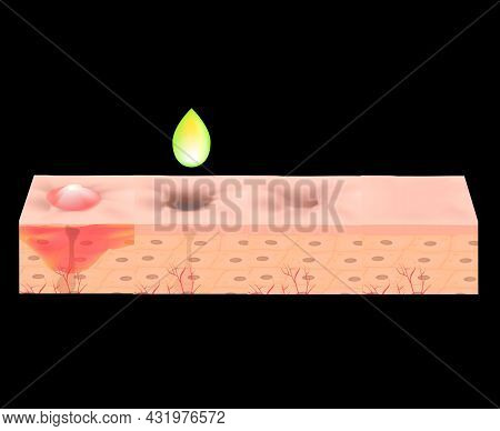 Atrophic Scars. Acne Scar. The Anatomical Structure Of The Skin With Acne. Illustration.