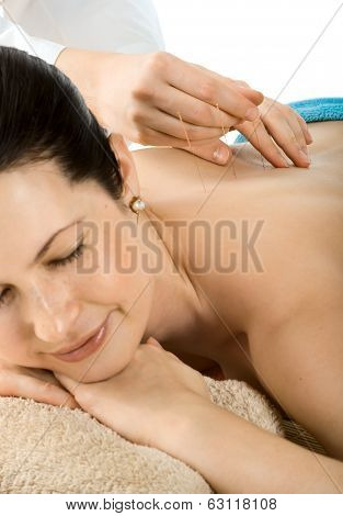 Acupuncture
