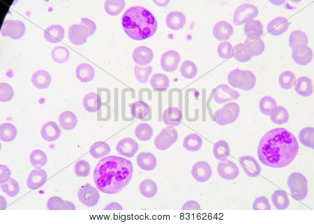 Pmn With Toxic Granule