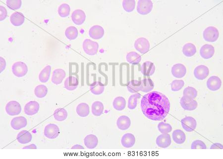 Pmn With Toxic Granule