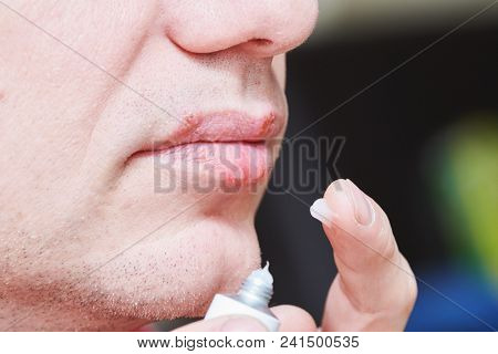 herpes simplex virus infection. Lips treatment by cream. Male face.