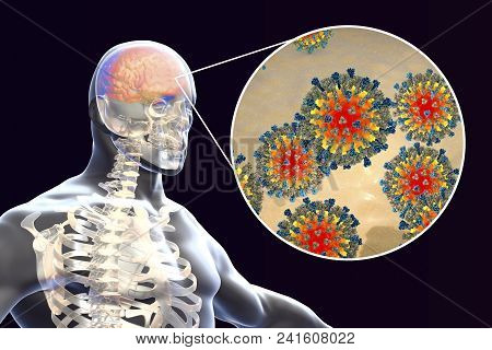 Measles-induced Encephalitis, Medical Concept, 3d Illustration Showing Brain Infection And Close-up 