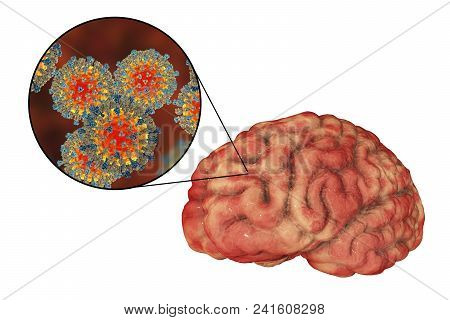 Measles-induced Encephalitis, Medical Concept, 3d Illustration Showing Brain Infection And Close-up 