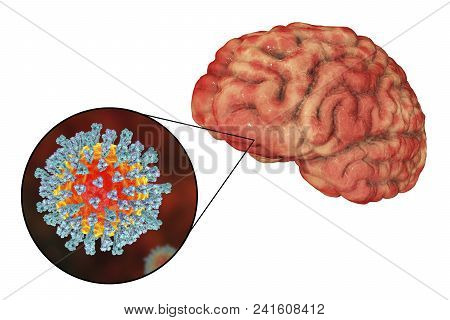 Measles-induced Encephalitis, Medical Concept, 3d Illustration Showing Brain Infection And Close-up 