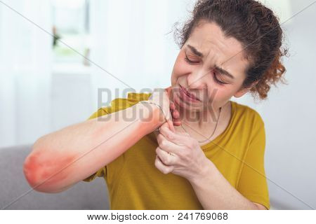 Unpleasant Soreness. Young Curly Woman Inspecting Red Soreness On Her Arm Caused By Wearing A Bracel