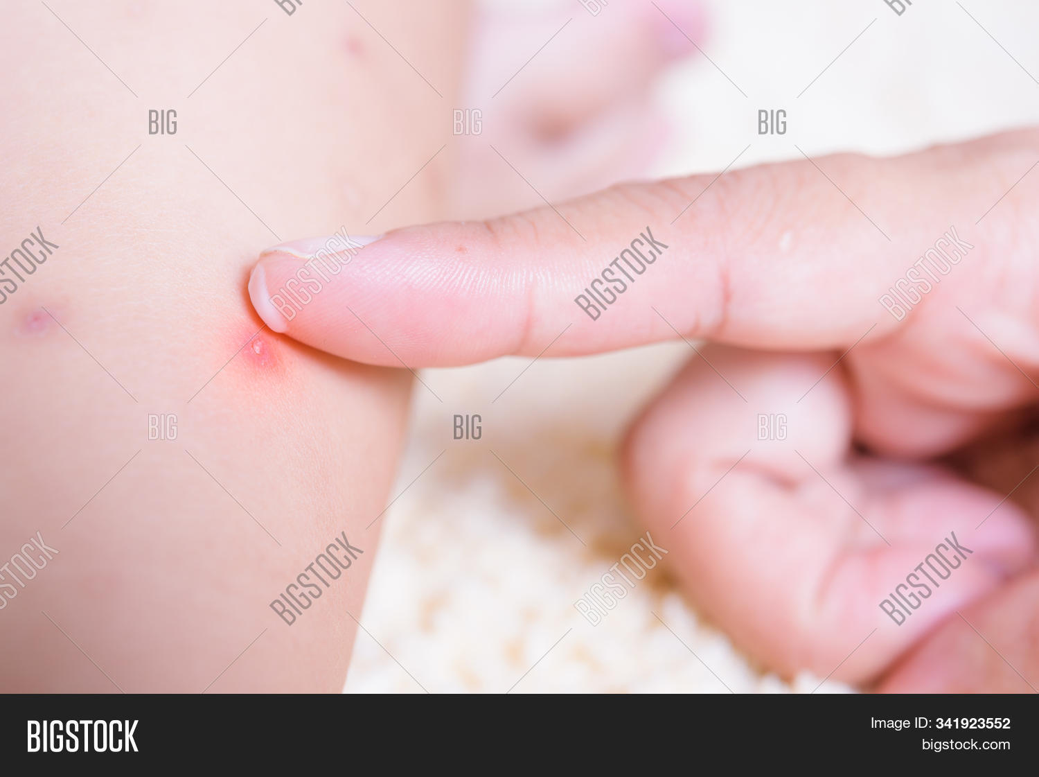 Kid Have Insect Bites Image & Photo (Free Trial) Bigstock