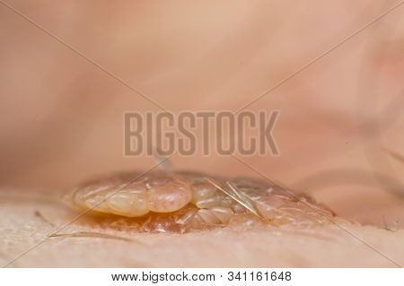 Macro Photo Of A Skin Wart, Papilloma Virus Infection