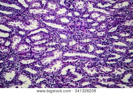 Chronic Nephritis, Light Micrograph, Photo Under Microscope