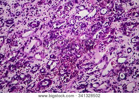Histopathology Of Interstitial Nephritis, Light Micrograph, Photo Under Microscope