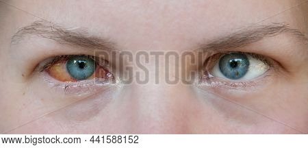 The Woman's Right Eye Is Sick With Keratitis. The Fibrous Tunic Of Eyeball Is Red. The Eye Is Watery