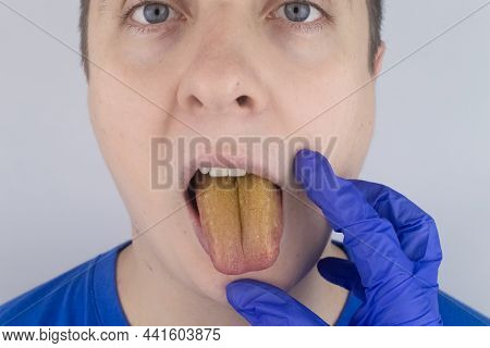 The Man Has A Yellow Tongue. Painful Yellow Coating On The Mucous Membrane Of The Tongue. Diseases O