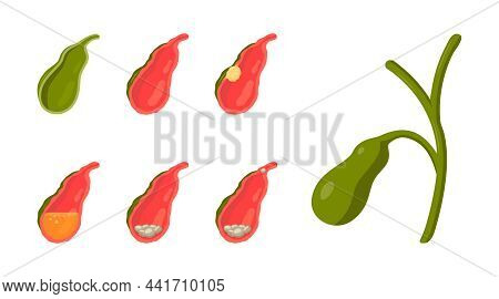 Gall Bladder Diseases In Cartoon Style, Vector