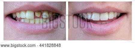 Smiling Woman With A Bad Tooth Before And After Treatment. Close-up. Veneers, Teeth Cleaning, Buildi