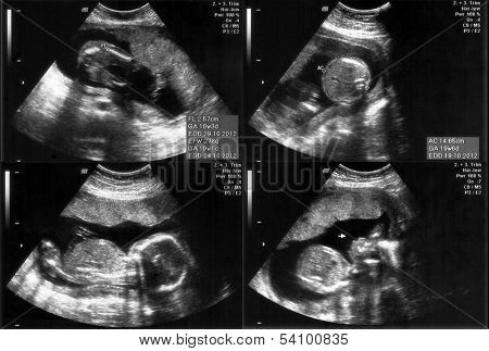 Ultrasound