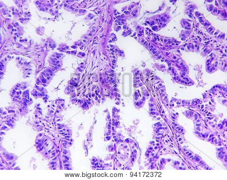 Well differentiated adenocarcinoma of a human