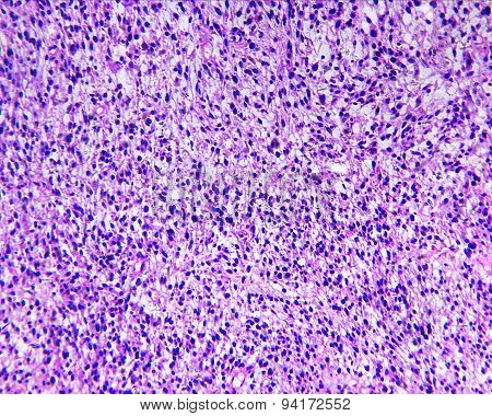 Rhabdomyosarcoma of a human
