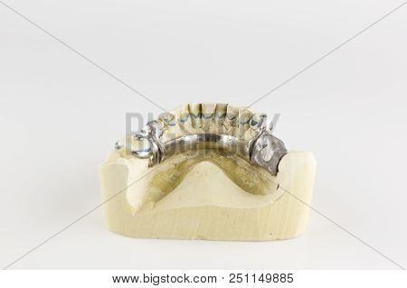Steel Base Of The Clasp Prosthesis On The Gypsum Model