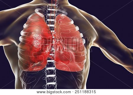Pneumonia Medical Concept, 3d Illustration Showing Lobar Pneumonia Of The Right Lung