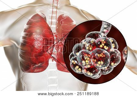 Pneumococcal Pneumonia, Medical Concept. 3d Illustration Showing Bacteria Streptococcus Pneumoniae I