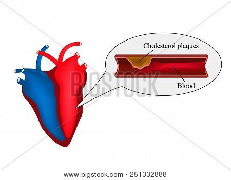 Atherosclerosis Of The Heart. Angina Pectoris. Heart Disease. World Heart Day. Vector Illustration O