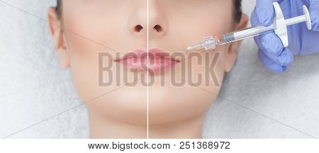 The Cosmetologist Makes Injections Of Botulinum Toxin In The Lips Of The Patient. Close-up Photo Bef