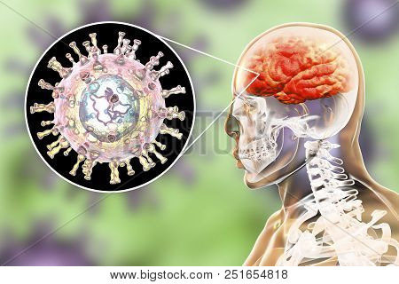 Varicella Zoster Virus Vzv Encephalitis, Medical Concept, 3d Illustration Showing Brain Infection An