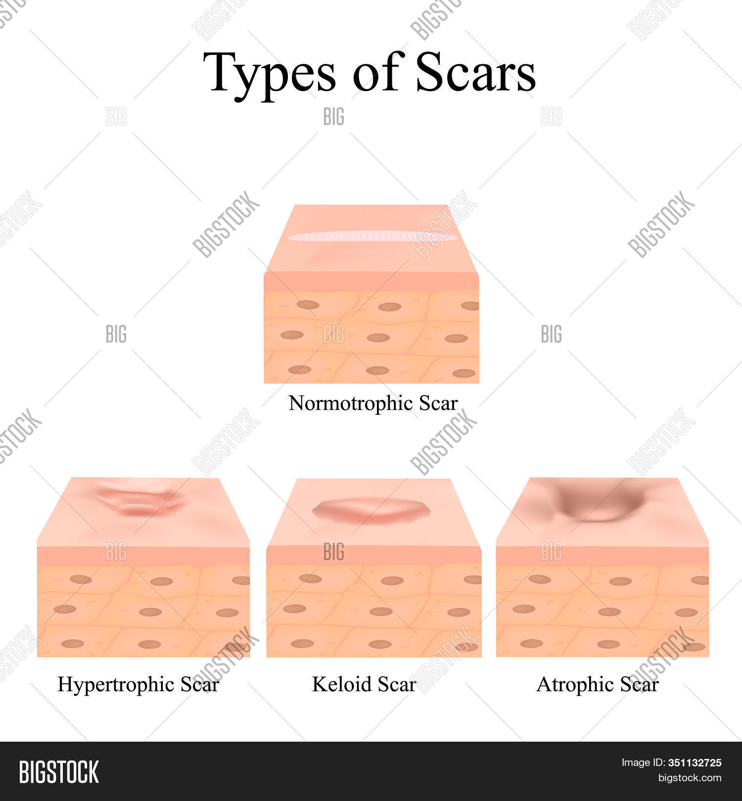 Imagen y foto Types Scars. Acne (prueba gratis) Bigstock