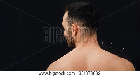 Close-up View From The Back Of A Male Patient With Acupuncture Needles In His Shoulder On A Black Ba