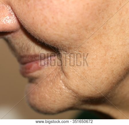 Nasolabial Wrinkles. Wrinkles On The Skin Of The Face Of The Neck. Flabby Cheeks And Neck