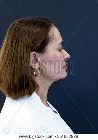 An Elderly Woman Immediately After Injections Of Botulinum Toxin, Closeup. Skin Care Concept. Aethet