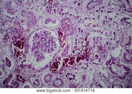 Acute Glomerulonephritis, Light Micrograph, Photo Under Microscope
