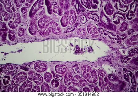 Diffuse Proliferative Glomerulonephritis, Dpgn, Light Micrograph, Photo Under Microscope