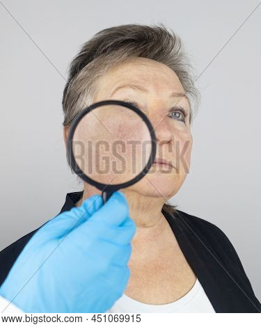 Rosacea On The Skin Of An Old Woman. Close-up Of A Capillary Network. Redness On The Skin. Problems