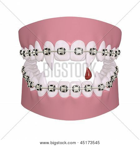 Vampire Braces