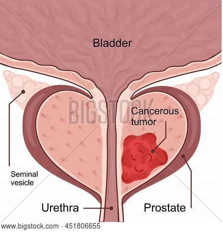 Medical Diagram Of 2 Stages Of Prostate Cancer.