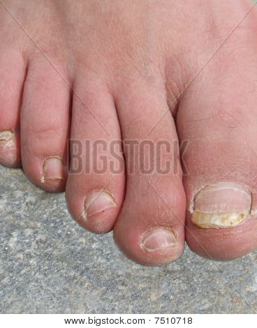 Toenails น่าเกลียด