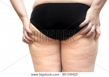 Buttock And Leg Cellulite Problem Young fat Woman Stretch Marks