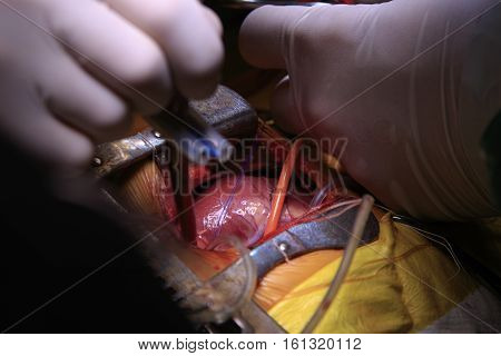 Surgeon pinches the tube and blocks the blood circulation during the open heart surgery