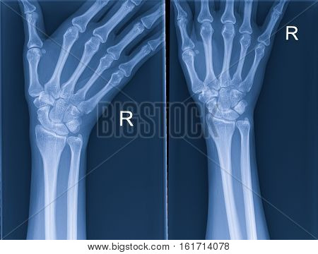 X-rays of the hand for a doctor examination.