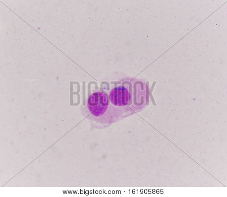 Abnomal Cells Look Like Malignant Cells