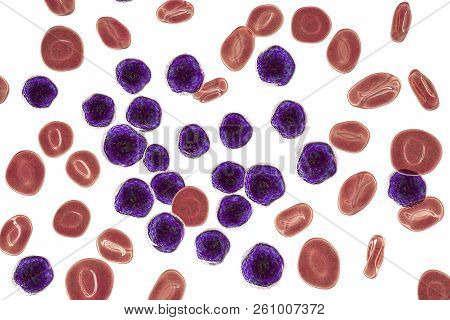 Acute Lymphoblastic Leukemia, Bone Marrow Smear, 3d Illustration