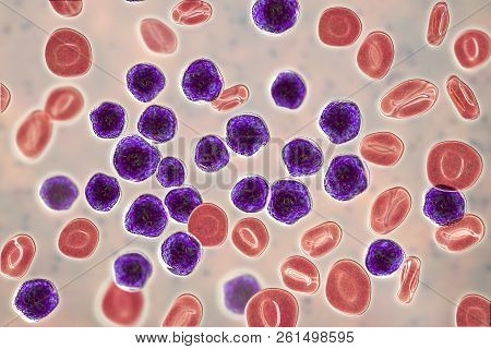 Acute Lymphoblastic Leukemia, Bone Marrow Smear, 3d Illustration
