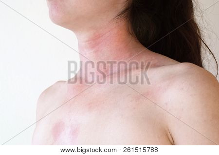Allergic Skin Reaction On The Female Neck And Face