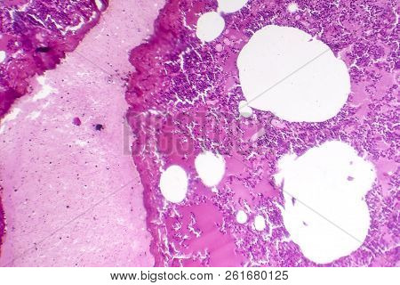 Lobar Pneumonia, Hemorrhagic Edema Period, Light Micrograph, Photo Under Microscope