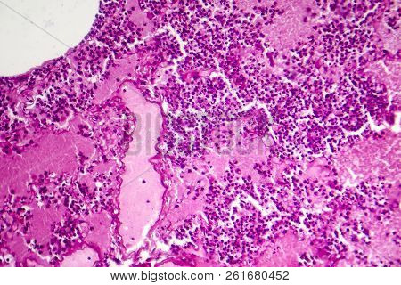 Lobar Pneumonia, Hemorrhagic Edema Period, Light Micrograph, Photo Under Microscope