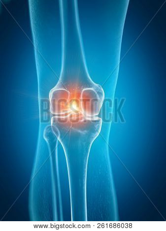 3d rendered medically accurate illustration of a painful knee