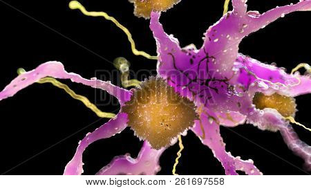 3d rendered medically accurate illustration of amyloid plaques on a alzheimer nerve cell