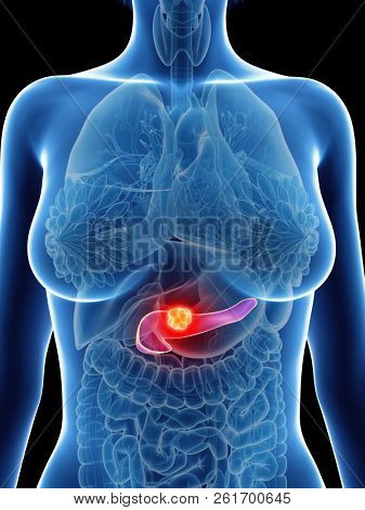 3d rendered medically accurate illustration of a womans pancreas cancer