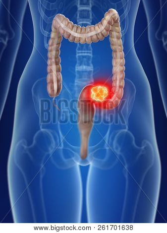 3d rendered medically accurate illustration of a womans colon cancer